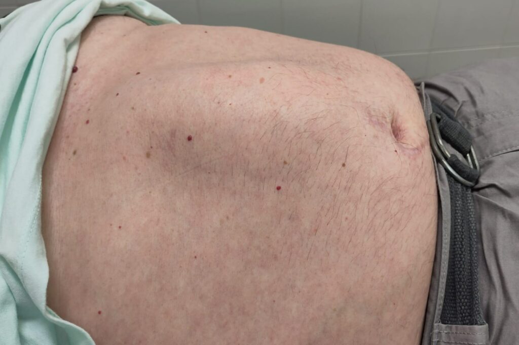 Abdomen masculino con protrusión de la pared abdominal